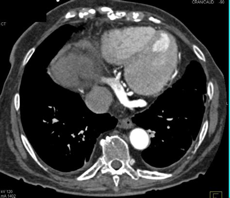 Mitral Annular Calcification Cardiac Case Studies Ctisus Ct Scanning