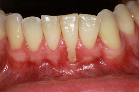 What Are The Causes Treatments Of Gingival Recession