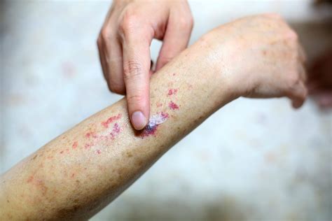 Cad Patients With Chronic Rashes Want More Answers Rare Disease Advisor