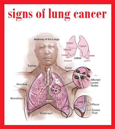 Many of the signs and symptoms can also be caused by other medical conditions but finding lung cancer early can mean that it's easier to treat. about lung cancer 3000: January 2013