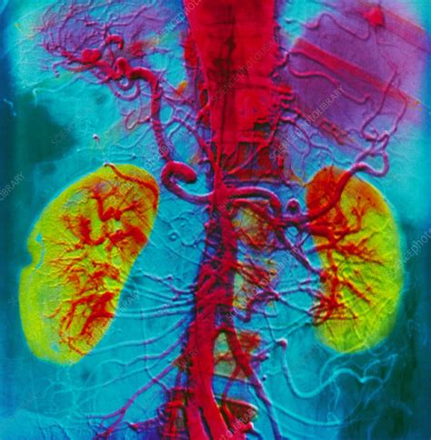 Angiogram Of Kidneys Stock Image P5500095 Science Photo Library