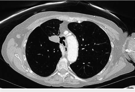 Computed Tomography Ct Scan Showing Tumor Near The Mediastinum And
