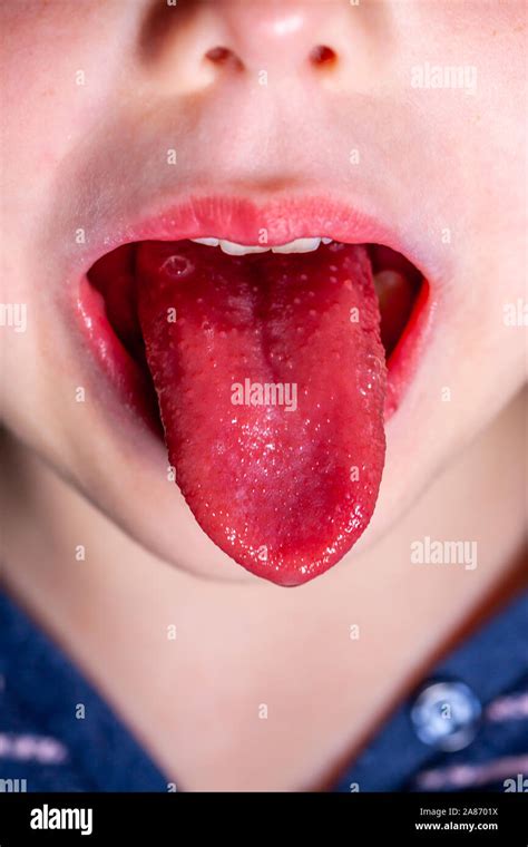 Scarlet Fever Hi Res Stock Photography And Images Alamy