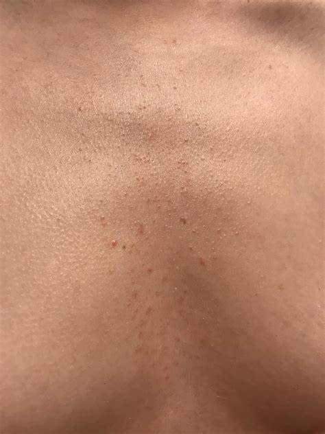 Skin Rash On Chest