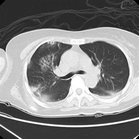 Computed Tomography Of The Thorax Of Patient 3 On Day 11 After