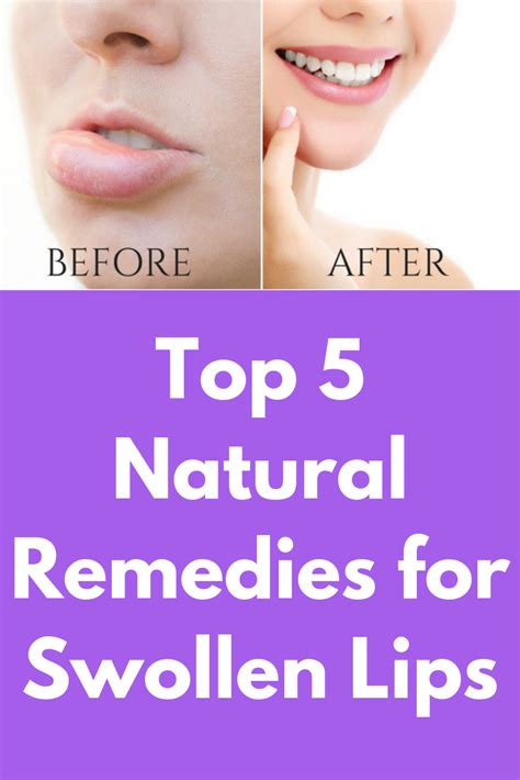 Top 5 Natural Remedies For Swollen Lips Are Your Lips Swollen And