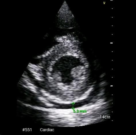 Myocarditis is an inflammatory disease of the myocardium with a wide range of clinical presentations, from subtle to devastating. Fulminant myocarditis: use of echocardiography from ...