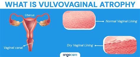 Vulvo Vaginal Atrophy Which Causes Problems And How It Is My XXX Hot Girl