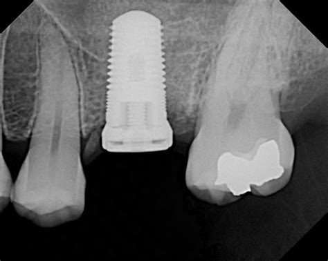 Complete Dental Implant Surgery Guide What To Expect
