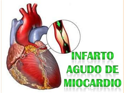 O enfarte agudo do miocárdio, conhecido como ataque cardíaco, ocorre quando uma artéria fica obstruída por um coágulo. Infarto agudo de miocardio