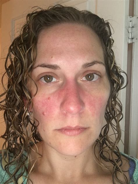 Please Help Malar Rash And Other Ss The Lupus Forum