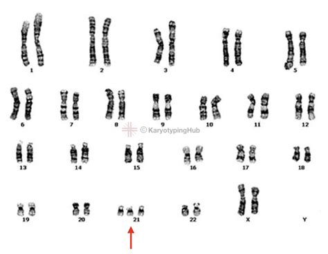 Karyotype Of Down Syndrome Trisomy 21 Explained Karyotypinghub