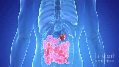 small intestine cancer photograph by sebastian kaulitzki science photo library pixels