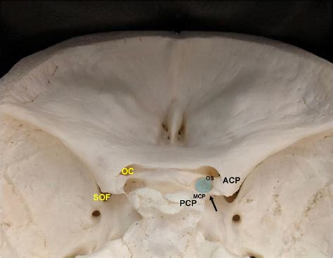 Anatomy And Variants Of The Anterior Clinoid Process The Anterior