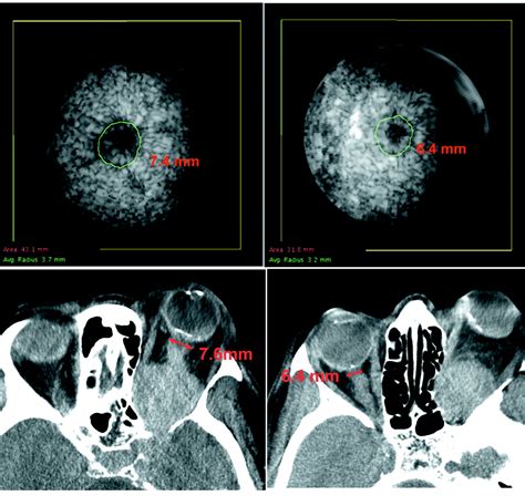 3d Ultrasound Coronal C Scan Imaging For Optic Nerve Sheath Meningioma