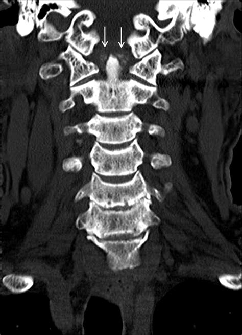 Poststroke Crowned Dens Syndrome The Spine Journal