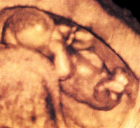 15 Weeks And 2 Days Pregnant Baby Fetal Progress Ultrasound