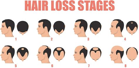 Male Pattern Baldness Hairpalace