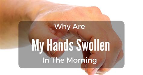 Why Are My Hands Swollen In The Morning The Most Complete Answers