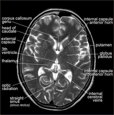 Basal Ganglia Anatomy Mri