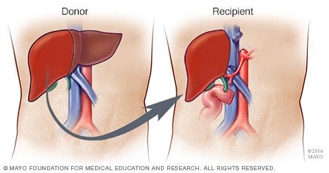 Living Donor Liver Transplant Type Mayo Clinic