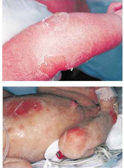 Staphylococcal Scalded Skin Syndrome Newborns Rr