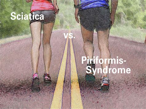 Care guide for piriformis syndrome. Pin on Sciatica