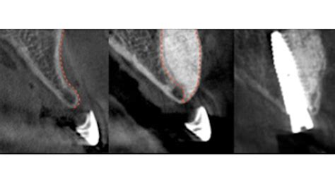 A New Minimally Invasive Bone Grafting Technique Smart Perio Implant