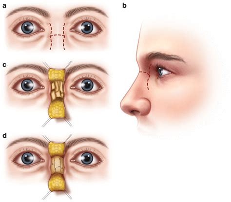 Naso-Orbito-Ethmoid Fractures | Ento Key