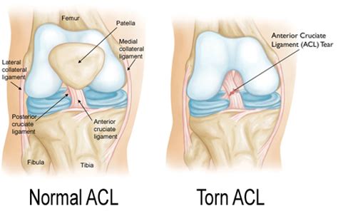 Acl tears are common among athletes and occur more frequently ligaments connect bones to bones. Doctors Experiment With Alternative Torn A.C.L. Solutions - SnowBrains