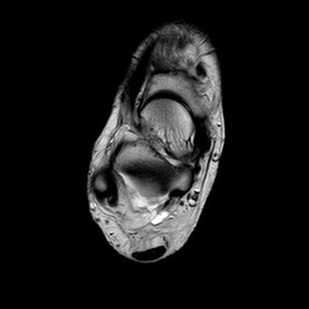 Calcaneal anterior process fracture | Image | Radiopaedia.org