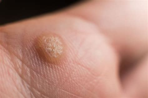 How To Identify A Wart U S Dermatology Partners