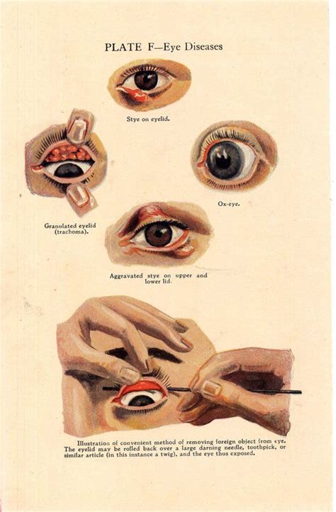 Yuck Human Eye Diseases This Hideous Full Color Medical Chart From The