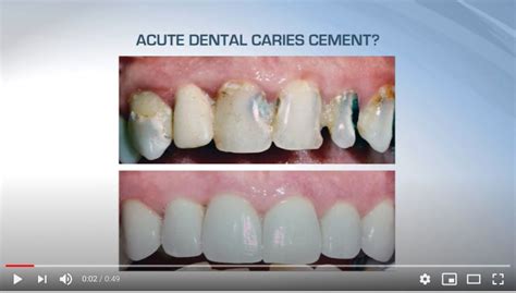 The New Glass Ionomers Really Work V3514 Operative Dentistry Ce