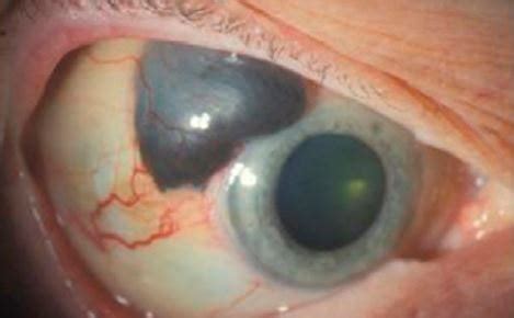 • chemicals that can cause cancer (direct acting carcinogens), • chemicals that do not cause cancer unless they are changed. What Is Melanoma Eye Cancer? - Teroes