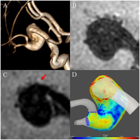 Frontiers Three Dimensional Aneurysm Wall Enhancement In Fusiform Intracranial Aneurysms Is