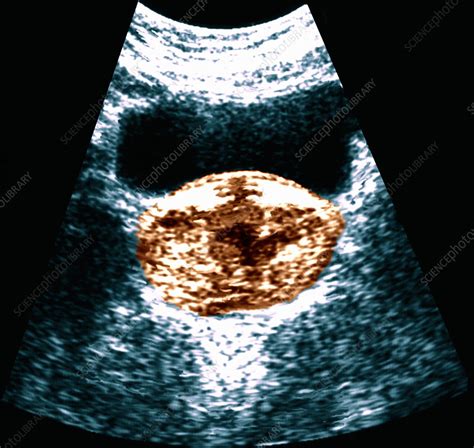 Prostate Cancer Ultrasound Scan Stock Image M8650192 Science