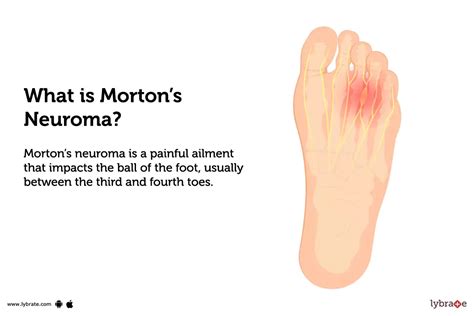 Mortons Neuroma Causes Symptoms Treatment And Cost