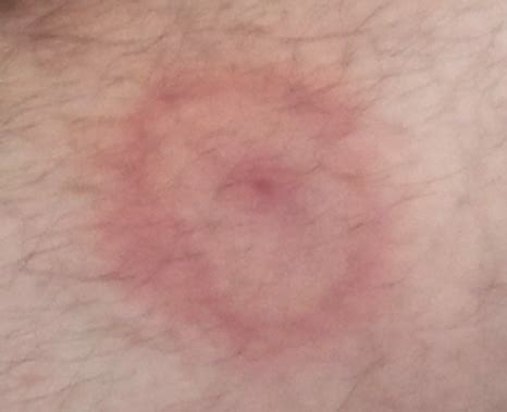The bullseye rash is a reasonably common allergic reaction after a bite from the 30% of people that get a bite from the black legged tick do not get a bullseye rash. Lyme Disease Bullseye Images - Astigmatism Glaucoma ...