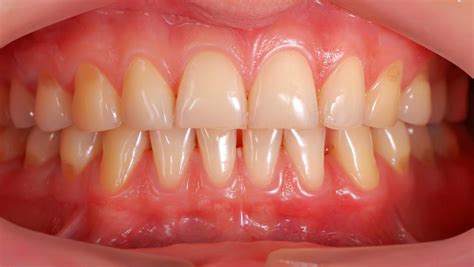 What Is Periodontium With Pictures