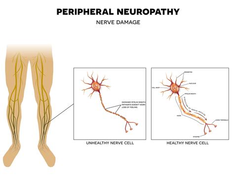 Peripheral Neuropathy Treatment Leg Nerve Pain And Foot Nerve Pain