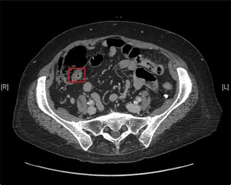 Ct Abdomen Demonstrating An Air And Fluid Filled Appendix Highlighted