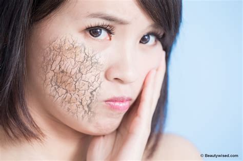 Dry Patches On Face 13 Easy To Do Proven Tips And Remedies Beautywised