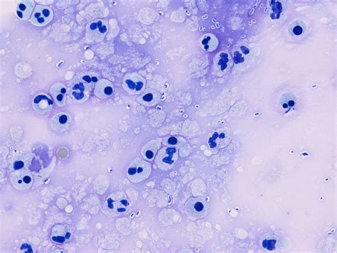 Streptococcus Pneumoniae Meningitis Csf Wellcome Collection