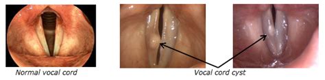 Vocal Cord Cysts The Royal Victorian Eye And Ear Hospital