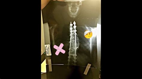 My Scoliosis Story Almost Paralyzed Youtube