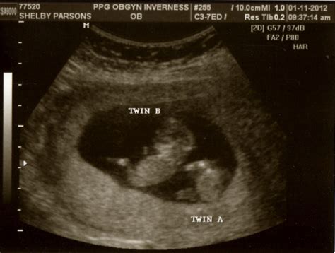 4 weeks pregnant with twins or multiples. The Parsons Family: Babies galore