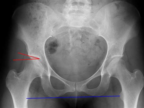 Prolotherapy For Hip Instability