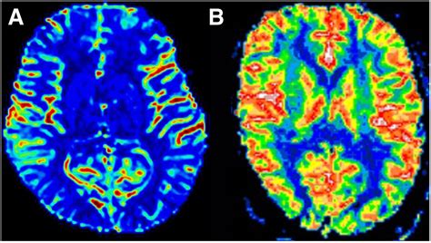 The Role Of Scintigraphy In Confirmation Of Suspected Brain Death