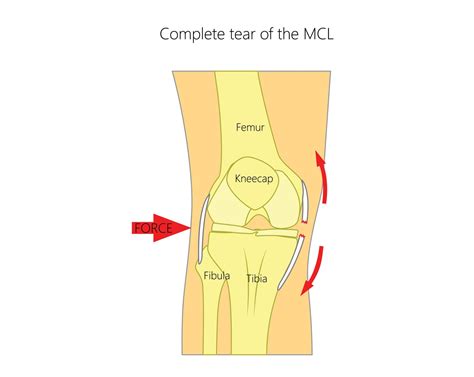 Medial Collateral Ligament Mcl Tears Upswing Health